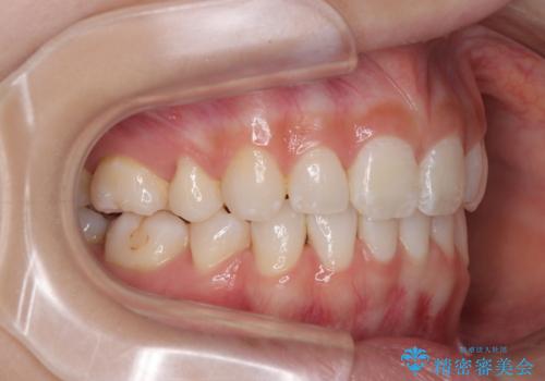 斜め前に飛び出した前歯 抜歯矯正で素敵な横顔にの治療後