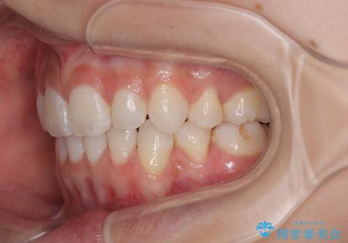 斜め前に飛び出した前歯 抜歯矯正で素敵な横顔にの治療後