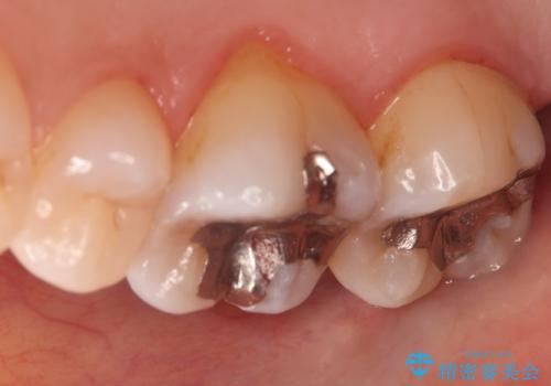 金属の被せ物を白くしたい【セラミックインレー】の治療前