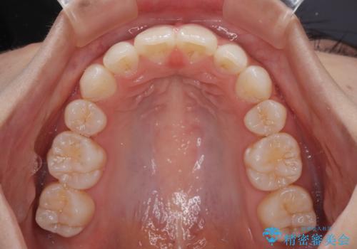 斜め前に飛び出した前歯 抜歯矯正で素敵な横顔にの治療後