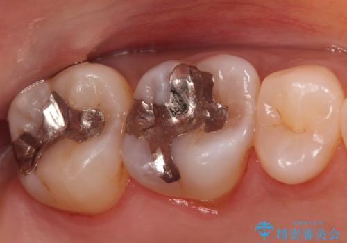 金属の被せ物を白くしたい【セラミックインレー】の症例 治療前
