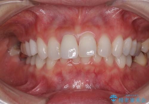 変色を綺麗にしたい 前歯と奥歯のオールセラミッククラウン治療の治療後
