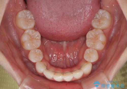 斜め前に飛び出した前歯 抜歯矯正で素敵な横顔にの治療後