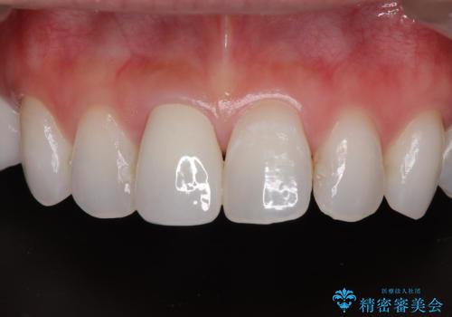 変色を綺麗にしたい 前歯と奥歯のオールセラミッククラウン治療の症例 治療後