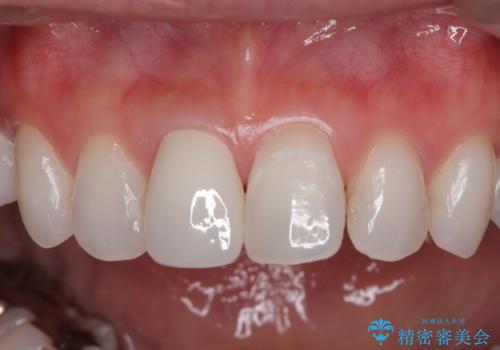 変色を綺麗にしたい 前歯と奥歯のオールセラミッククラウン治療の治療後