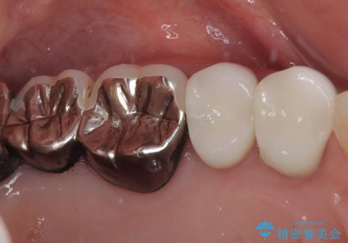 変色を綺麗にしたい 前歯と奥歯のオールセラミッククラウン治療の治療後