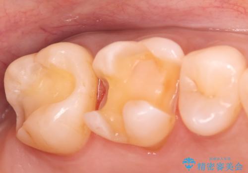 金属の被せ物を白くしたい【セラミックインレー】の治療中