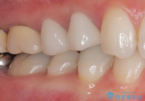 変色を綺麗にしたい 前歯と奥歯のオールセラミッククラウン治療の治療後