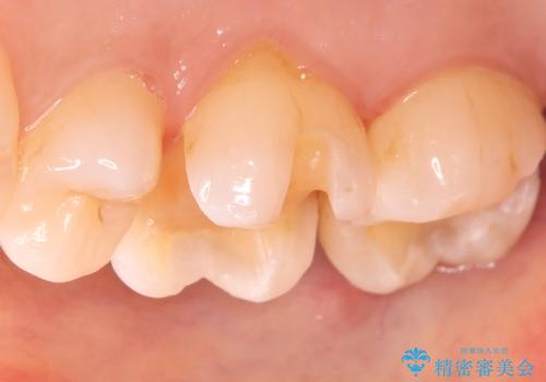 金属の被せ物を白くしたい【セラミックインレー】の治療中