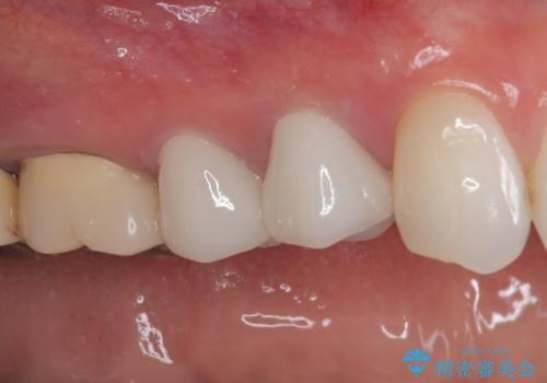 変色を綺麗にしたい 前歯と奥歯のオールセラミッククラウン治療の治療後