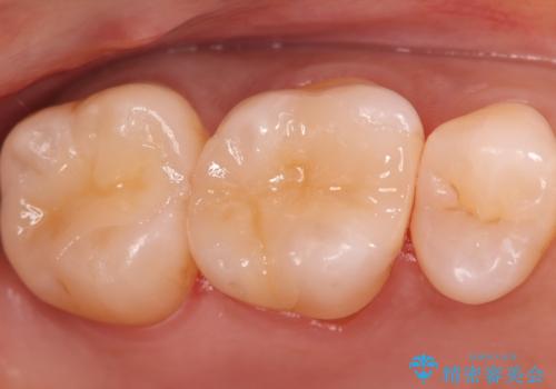 金属の被せ物を白くしたい【セラミックインレー】の症例 治療後