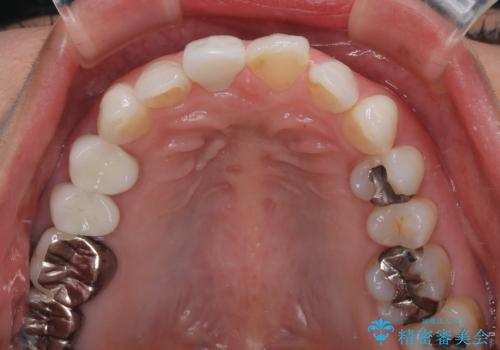 変色を綺麗にしたい 前歯と奥歯のオールセラミッククラウン治療の治療後