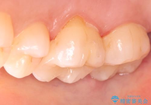 金属の被せ物を白くしたい【セラミックインレー】の治療後