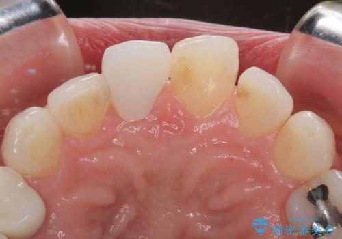 変色を綺麗にしたい 前歯と奥歯のオールセラミッククラウン治療の治療後