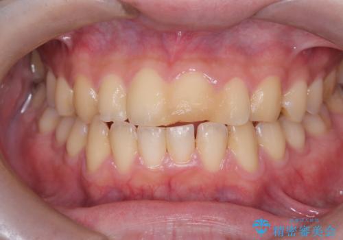 サーフィンで前歯をぶつけて歯が欠けた|かかりつけ医で治療困難と言われ当院へ来院|VPT(生活歯髄療法)で神経を保存|前歯の見た目も改善の治療前