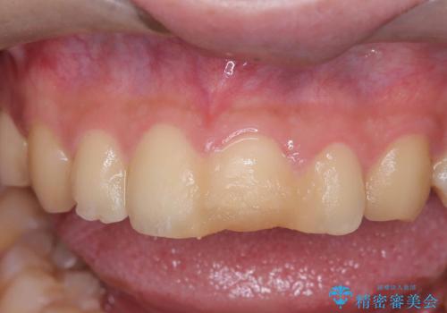 サーフィンで前歯をぶつけて歯が欠けた|かかりつけ医で治療困難と言われ当院へ来院|VPT(生活歯髄療法)で神経を保存|前歯の見た目も改善の治療前