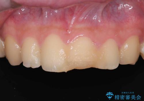 サーフィンで前歯をぶつけて歯が欠けた|かかりつけ医で治療困難と言われ当院へ来院|VPT(生活歯髄療法)で神経を保存|前歯の見た目も改善の治療前