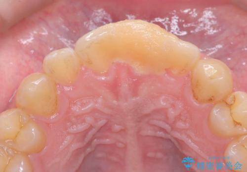 サーフィンで前歯をぶつけて歯が欠けた|かかりつけ医で治療困難と言われ当院へ来院|VPT(生活歯髄療法)で神経を保存|前歯の見た目も改善の治療前