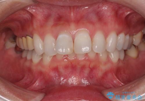 変色を綺麗にしたい 前歯と奥歯のオールセラミッククラウン治療の治療前