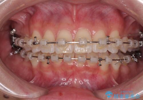 デコボコの非抜歯矯正 ワイヤー装置で楽して改善の治療中