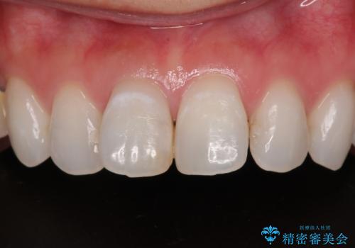 変色を綺麗にしたい 前歯と奥歯のオールセラミッククラウン治療の症例 治療前