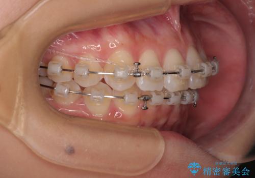 デコボコの非抜歯矯正 ワイヤー装置で楽して改善の治療中