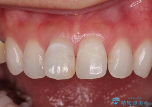 変色を綺麗にしたい 前歯と奥歯のオールセラミッククラウン治療の治療前