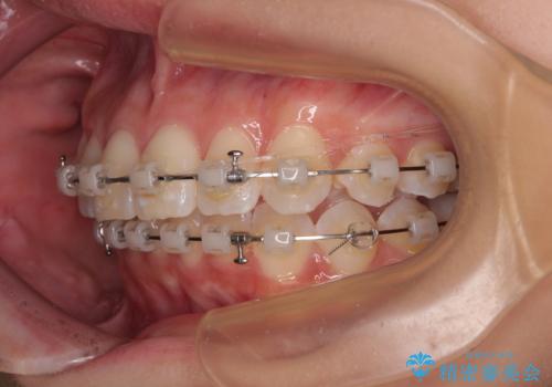 デコボコの非抜歯矯正 ワイヤー装置で楽して改善の治療中