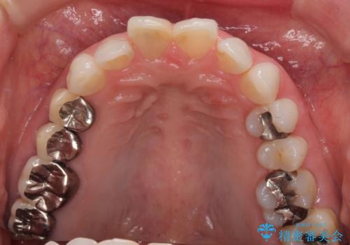 変色を綺麗にしたい 前歯と奥歯のオールセラミッククラウン治療の治療前