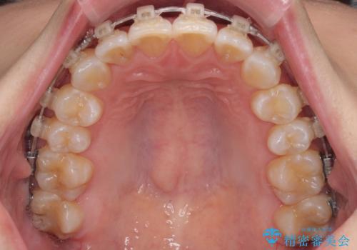 デコボコの非抜歯矯正 ワイヤー装置で楽して改善の治療中