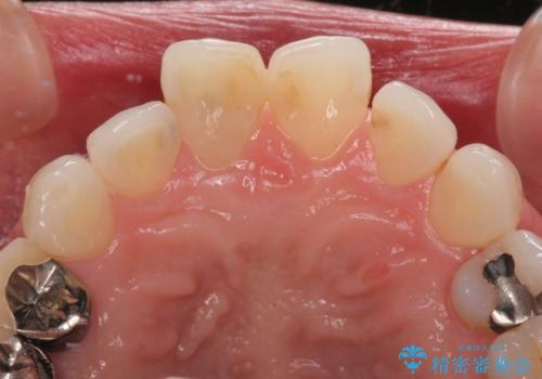 変色を綺麗にしたい 前歯と奥歯のオールセラミッククラウン治療の治療前