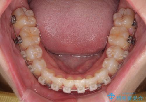 デコボコの非抜歯矯正 ワイヤー装置で楽して改善の治療中