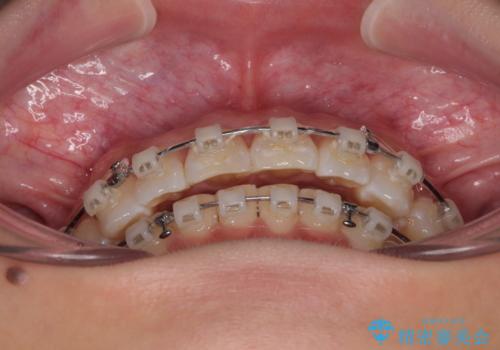 デコボコの非抜歯矯正 ワイヤー装置で楽して改善の治療中