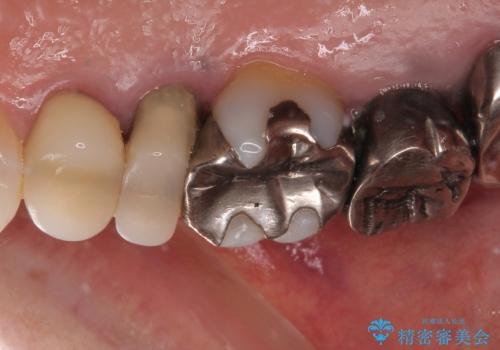 米粒のような小さい歯 セラミッククラウンでバランスを改善の治療前