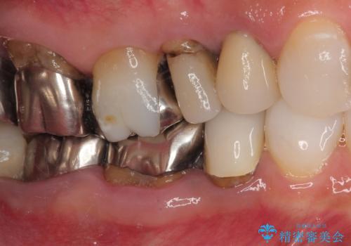 米粒のような小さい歯 セラミッククラウンでバランスを改善の治療前