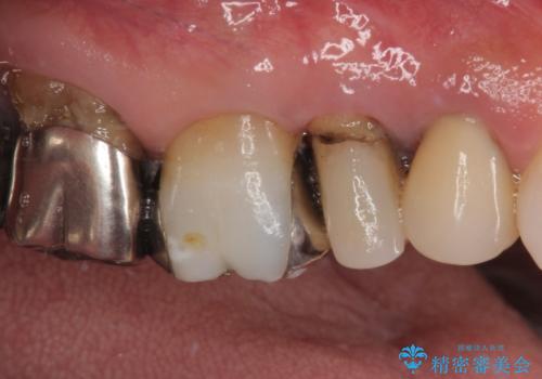 米粒のような小さい歯 セラミッククラウンでバランスを改善の治療前