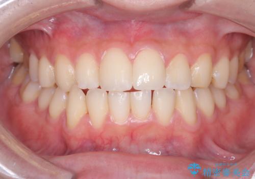 サーフィンで前歯をぶつけて歯が欠けた|かかりつけ医で治療困難と言われ当院へ来院|VPT(生活歯髄療法)で神経を保存|前歯の見た目も改善の治療後