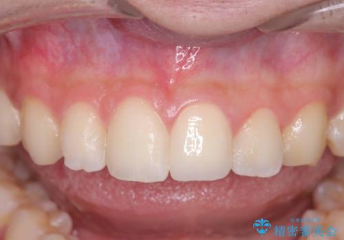 サーフィンで前歯をぶつけて歯が欠けた|かかりつけ医で治療困難と言われ当院へ来院|VPT(生活歯髄療法)で神経を保存|前歯の見た目も改善の治療後