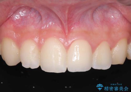 サーフィンで前歯をぶつけて歯が欠けた|かかりつけ医で治療困難と言われ当院へ来院|VPT(生活歯髄療法)で神経を保存|前歯の見た目も改善