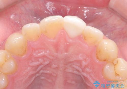 サーフィンで前歯をぶつけて歯が欠けた|かかりつけ医で治療困難と言われ当院へ来院|VPT(生活歯髄療法)で神経を保存|前歯の見た目も改善の治療後