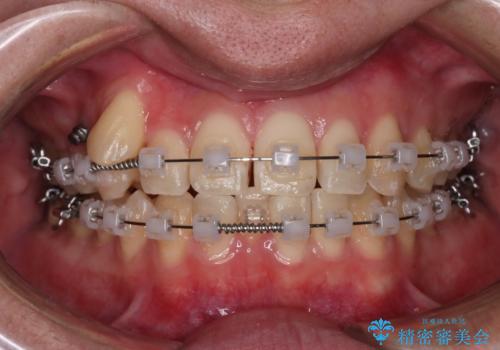 【クリア装置】八重歯とがたつきを綺麗にの治療中