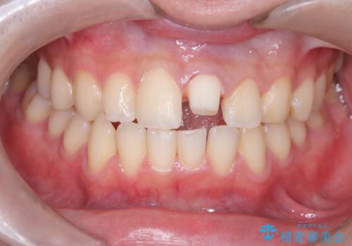 サーフィンで前歯をぶつけて歯が欠けた|かかりつけ医で治療困難と言われ当院へ来院|VPT(生活歯髄療法)で神経を保存|前歯の見た目も改善の治療中