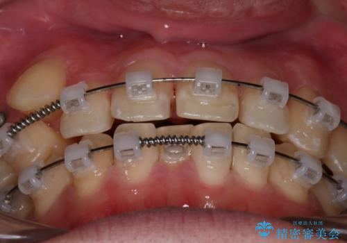【クリア装置】八重歯とがたつきを綺麗にの治療中