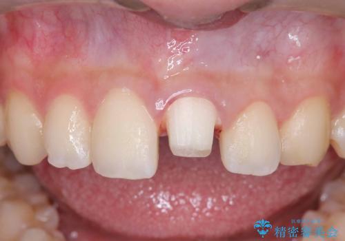 サーフィンで前歯をぶつけて歯が欠けた|かかりつけ医で治療困難と言われ当院へ来院|VPT(生活歯髄療法)で神経を保存|前歯の見た目も改善の治療中