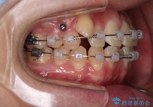 【クリア装置】八重歯とがたつきを綺麗にの治療中