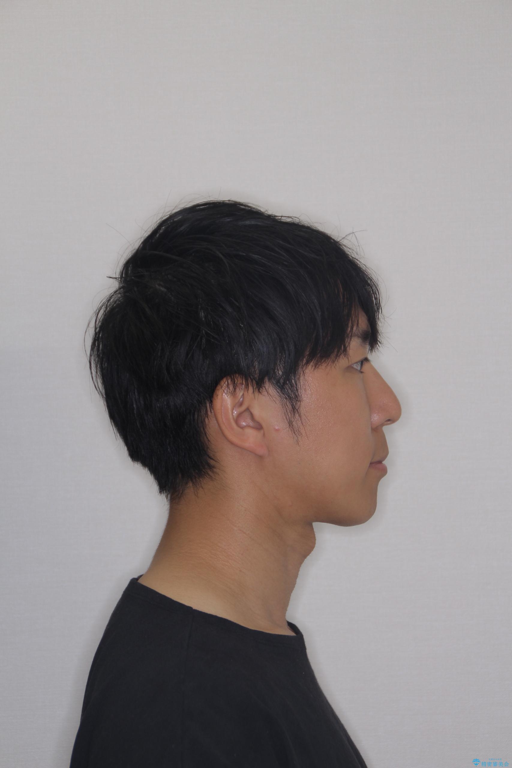 【モニター】前歯のデコボコと口元の出っ張りを改善!目立たない矯正で自然な笑顔にの治療前(顔貌)