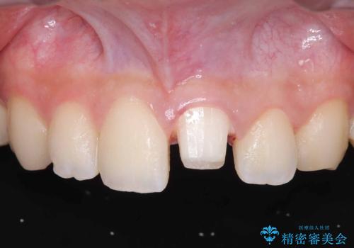 サーフィンで前歯をぶつけて歯が欠けた|かかりつけ医で治療困難と言われ当院へ来院|VPT(生活歯髄療法)で神経を保存|前歯の見た目も改善の治療中