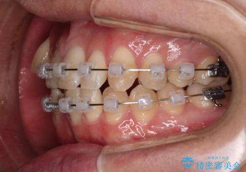 【クリア装置】八重歯とがたつきを綺麗にの治療中