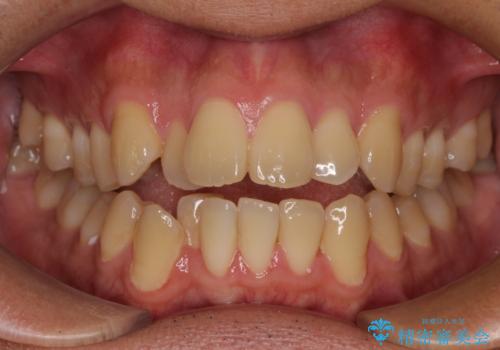 【モニター】前歯のデコボコと口元の出っ張りを改善!目立たない矯正で自然な笑顔にの治療前