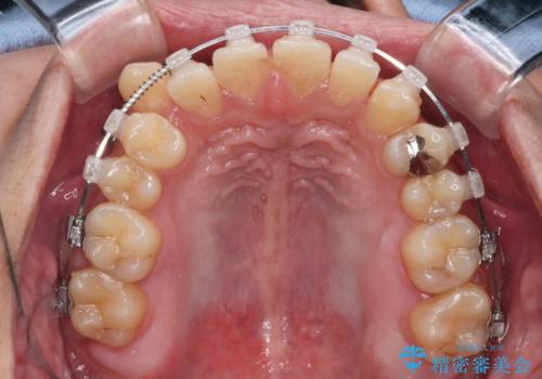 【クリア装置】八重歯とがたつきを綺麗にの治療中